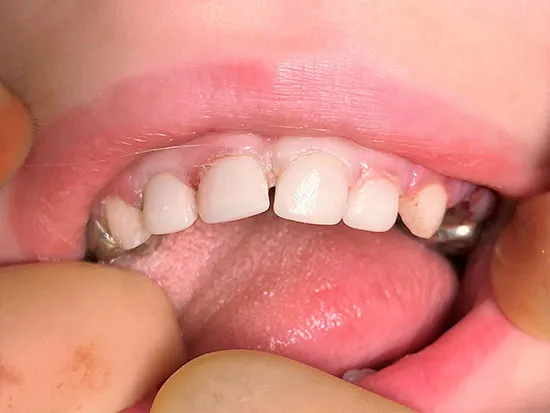 child's teeth after crowns